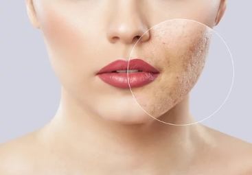 Scar Removal Treatment at Asperia Cosmo Care at Raipur