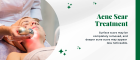 Acne Scar treatment